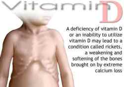 deficiency vitamin symptoms effects osteomalacia